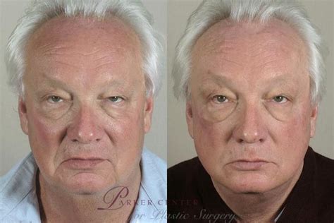 Facelift Before And After Photo Gallery Paramus New Jersey Parker Center For Plastic Surgery