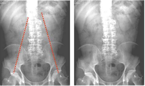 Imaging Lumbar Spine Sij Flashcards Quizlet