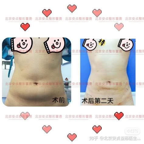 女性腰腹吸脂 知乎