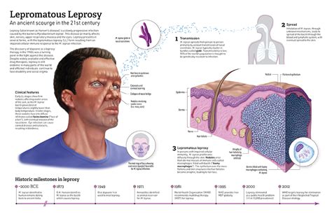 Leprosy Diagram