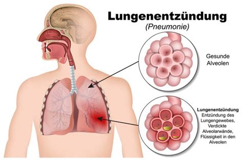 Lungenentz Ndung Was Ist Das Pneumonie Inhalation De