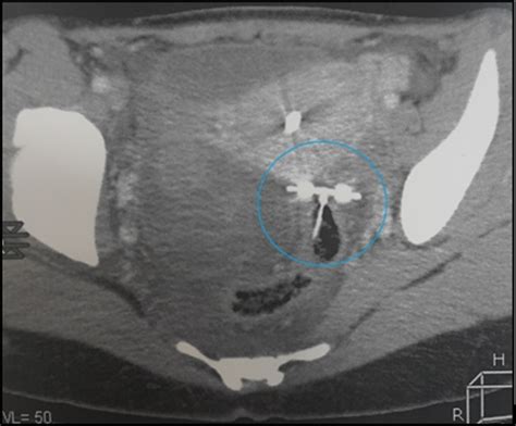 Pelvic Abscess Complicating Sigmoid Colon Perforation By Migrating Intrauterine Device A Case