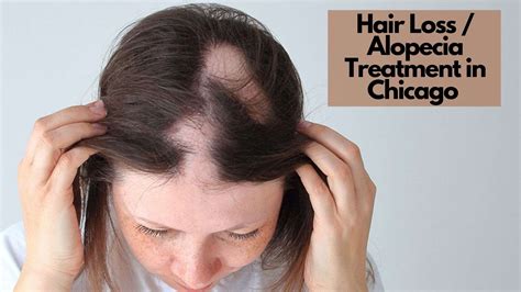 Alopecia Areata Treatment Before And After