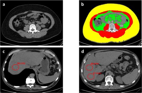 Prognostic Value Of Preoperative CT Scan Derived Body Composition