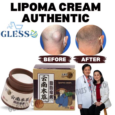 Lipoma Removal Cream Treat Tumor Skin Swelling Ointment Natural