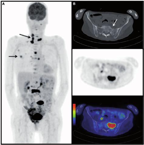 Metastatic head and neck paraganglioma in SDHB genetic mutation. (A)... | Download Scientific ...