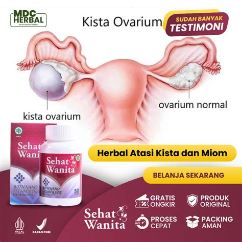 Jual Obat Kista Dan Miom Myom Herbal Coklat Kista Endometriosis Cysta