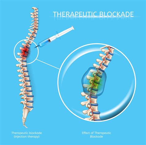 Diagnostic Medial Branch Block – Associated Pain Specialist