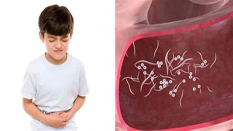 How To Treat Pinworms With Herbal Remedies Get Rid Of Pinworms With