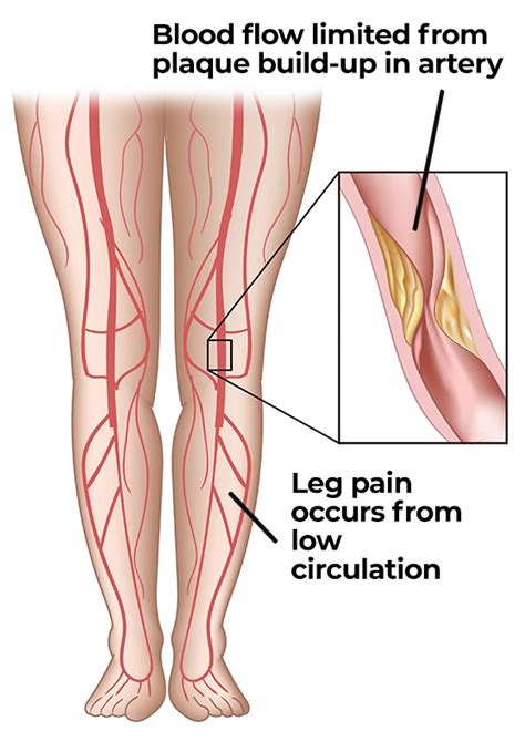 No Circulation In Legs Sinrefarmamiento