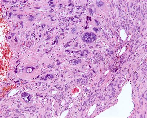 Pathology Outlines Leiomyoma General