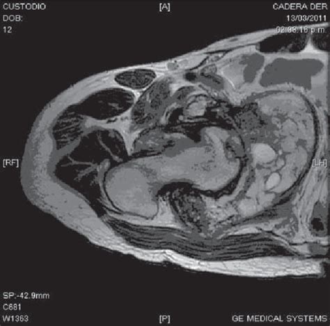 Pdf Pelvic Chondroblastoma In An Adolescent New Treatment Approach