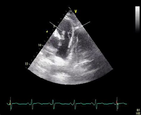 Isolated Pulmonary Valve Endocarditis In A Patient With Aplastic Anaemia Bmj Case Reports