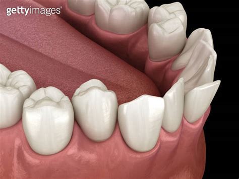 Overcrowded Teeth Abnormal Dental Occlusion Medically Accurate Tooth