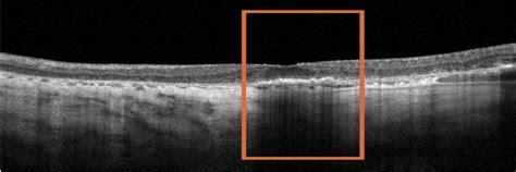 Geographic Atrophy | How to Diagnose GA + When to Refer