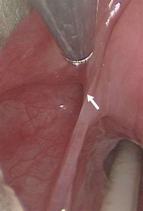 Direct Laryngoscopy Performed In Operating Room Showed Pyriform Sinus Download Scientific