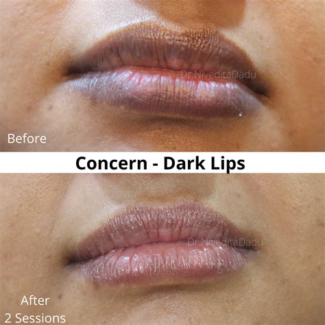 Dark Lips Dark Lips Skin Clinic Skin Specialist Doctor