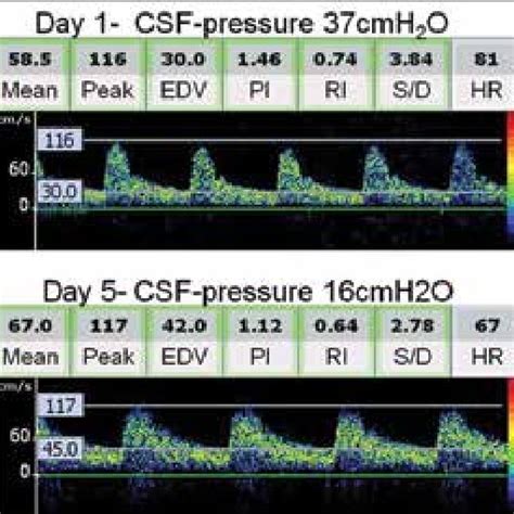 Serial Transcranial Doppler Tcd Spectra And Intracranial Pressure