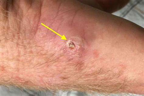 Squamous Cell Carcinoma Hand Surgery Resource