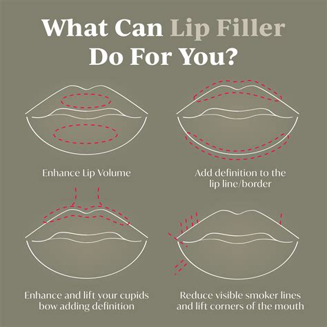 Lip Fillers London Artofit