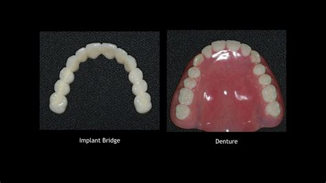 All On 4 Implants Vs Dentures The Pros And Cons Of Each YouTube