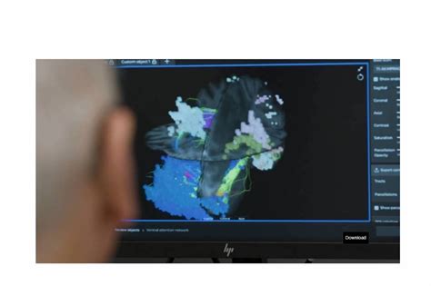 New Brain Mapping Tech At Baptist Health Miami Neuroscience Institute