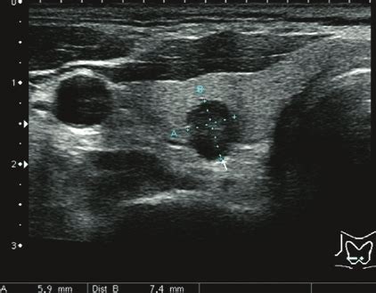 Normal Thyroid Gland Ultrasound