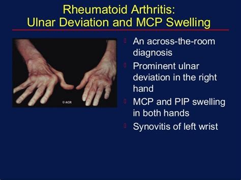 Inflammatory Arthritis An Overview