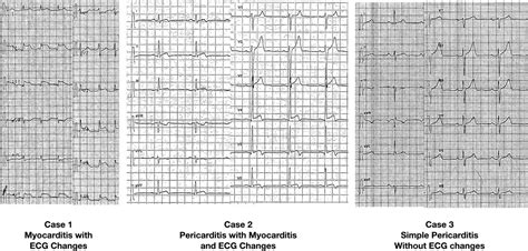 Stemi Vs Pericarditis Ecg