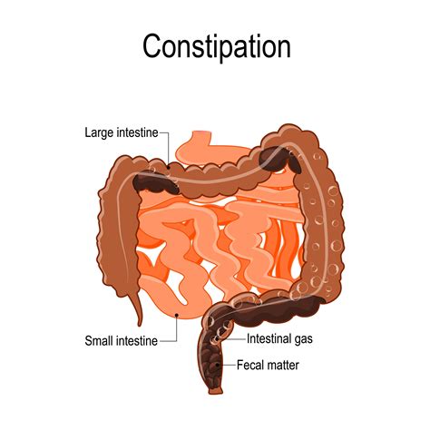 What Is Constipation Medizzy