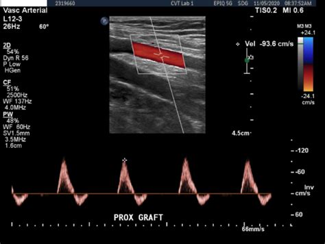 Lower Extremity Bypass Baton Rouge | Peripheral Vascular Bypass