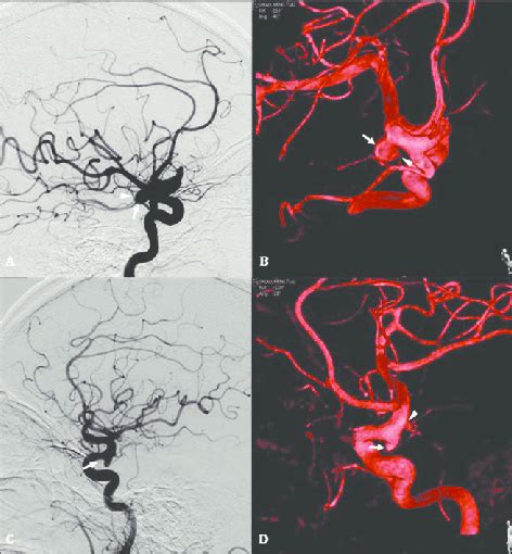 Digital Subtraction Angiography A And A Three Dimensional