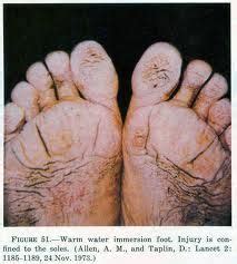 Trench Foot Ww1