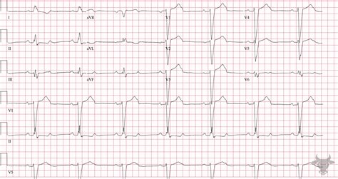 Second Degree Atrioventricular Block 2:1 | ECG Stampede