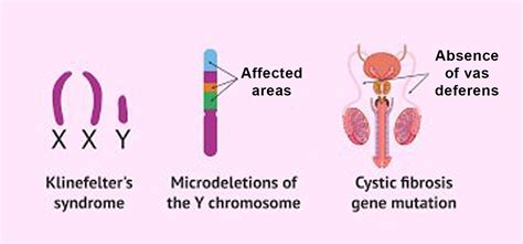 Unraveling The Role Of Genetics In Male Infertility Understanding The