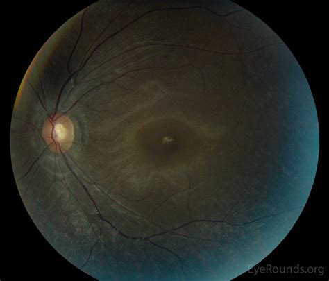 Bull S Eye Maculopathy Due To Hydroxychloroquine Toxicity