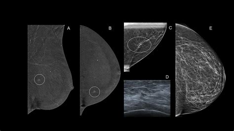 Contrast Enhanced Mammography In Breast Cancer Screening European