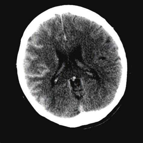 Brain Computed Tomography Following Cerebral Angiography Shows Marked Download Scientific