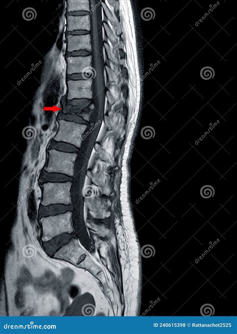 Lumbar Compression Fracture Mri