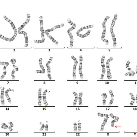 Chromosomal Analyses Revealed A Karyotype Of 46xxdelq24 Download Scientific Diagram