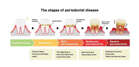 Orange, CA Periodontal Treatments for Gum Disease