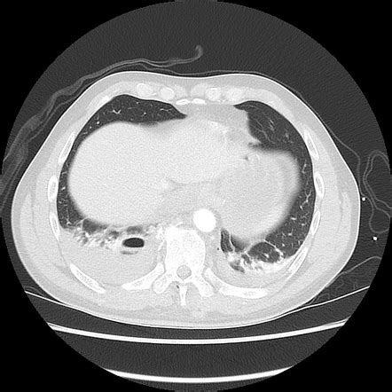 Pneumatocele | Radiology Reference Article | Radiopaedia.org