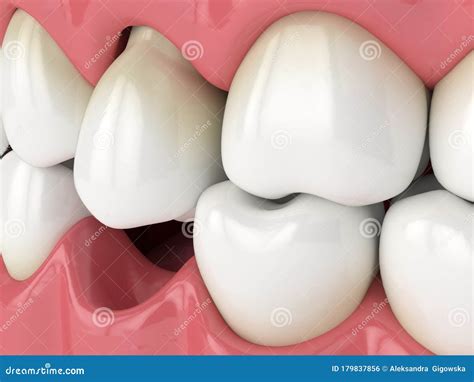 D Render Of Jaw With Protruding Tooth Revealing Root Stock Photo