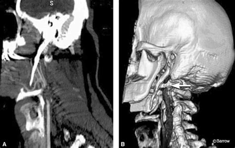 Bilateral Elongated Styloid Processes Eagle S Syndrome Barrow