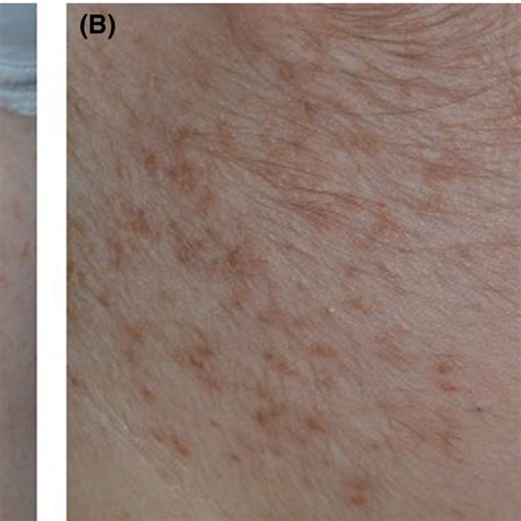 A B Multiple Reddish‐brown Greasy Papules Localized On Abdomen And On Download Scientific