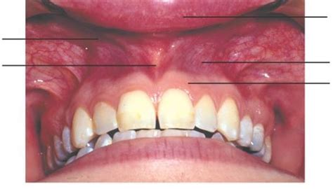 Maxillary Labial Mucosa Diagram Quizlet