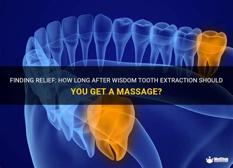 Finding Relief How Long After Wisdom Tooth Extraction Should You Get A Massage Medshun