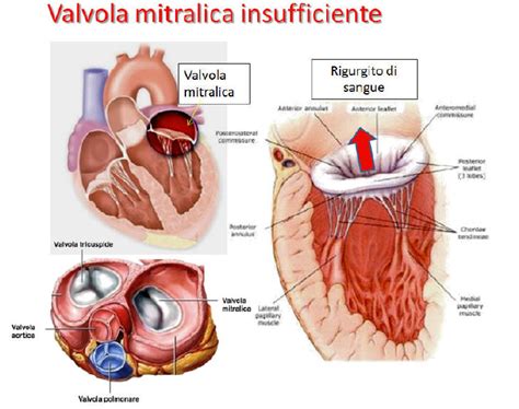 Insufficienza Della Valvola Mitralica Il Soffio Al Cuore