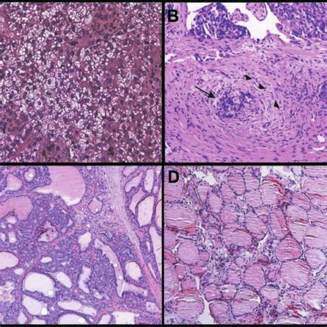 Photomicrographs Of Tissue Sections From Case Hematoxylin And Eosin