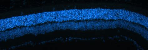 Groupe Recherche sur les maladies de la rétine Retinal disorder